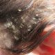 Beauty tips- Hair Problems